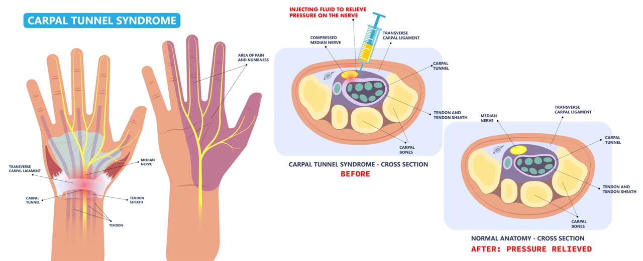 Hydrodissection Kochan Pain Treatment Center